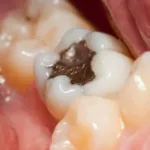 दांत का कीड़ा कैसा दिखता है